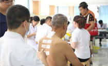三伏贴是什么 三伏贴可以治疗湿疹吗