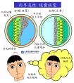 <晕眩耳鸣专栏>重感冒后走路歪斜、平躺晕眩？就医发现是内耳炎性球囊病变