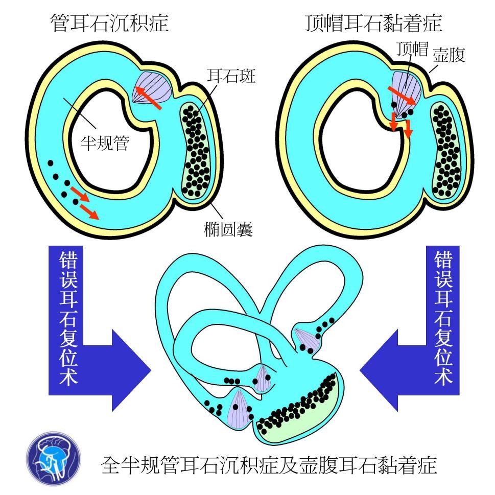 <晕眩耳鸣专栏>耳石脱落症:不只是晕眩,还可能导致头痛