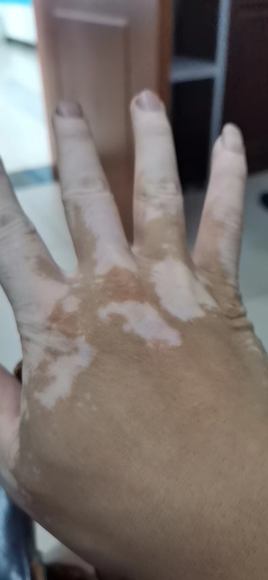 希格玛308光疗仪科普：早期的白癜风能治愈吗？