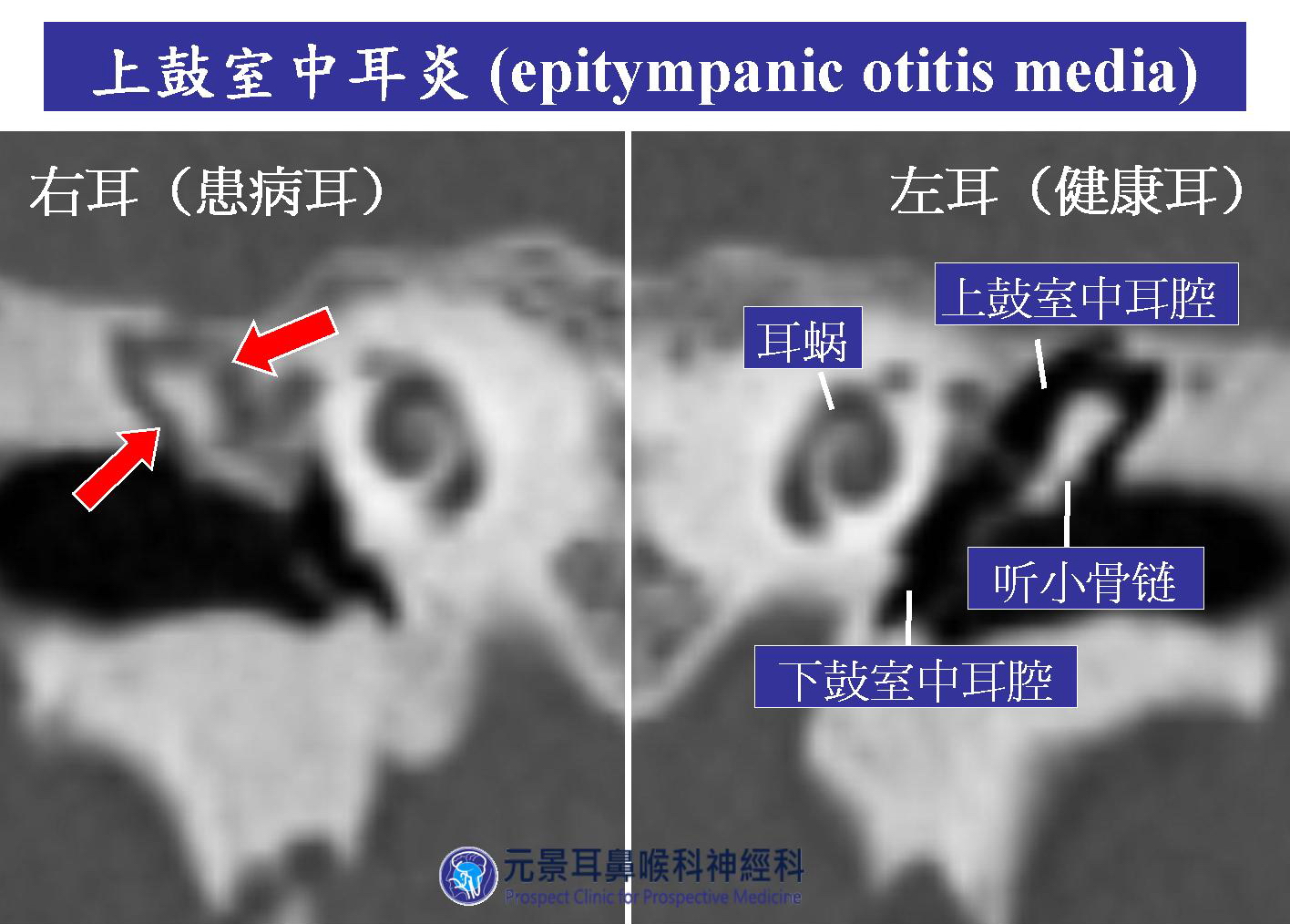 从感冒到持续耳闷，台湾耳鸣名医说明上鼓室中耳炎案例