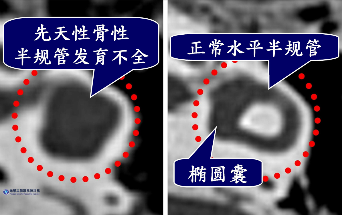 快速转头就晕眩不适?台湾晕眩名医师建议,先治内耳发炎再治疗