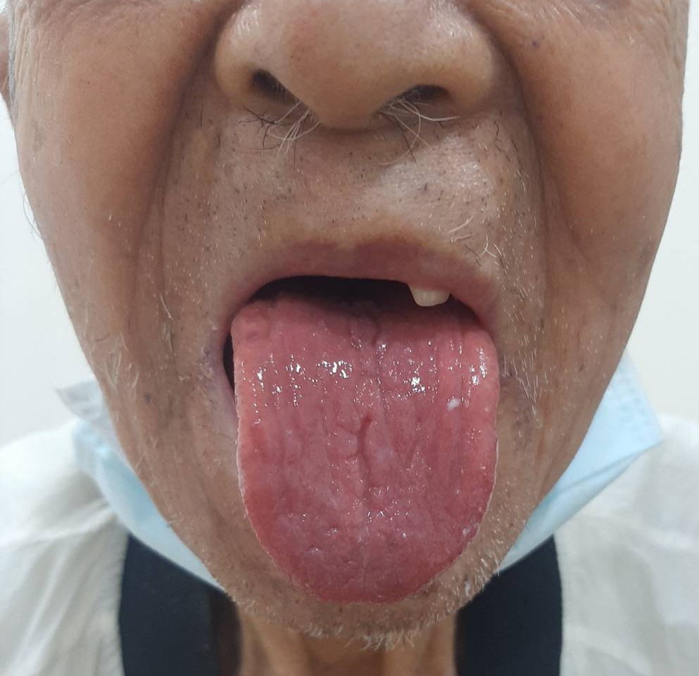 吃巧克力导致口腔灼痛?医生揭秘:竟是对“蟑螂过敏”!