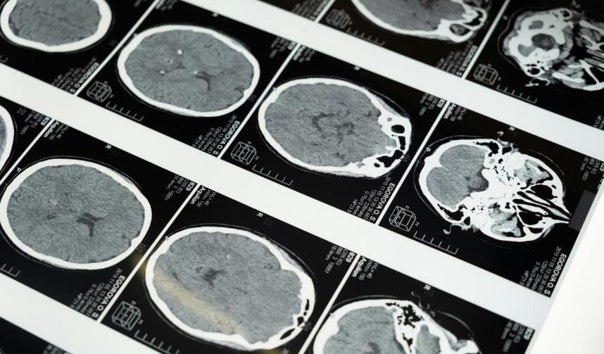 脑卒中急救：抓住黄金救治期，守护生命，不留遗憾	