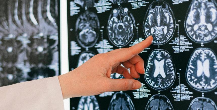 脑血管疾病筛查：早做这一步，远离脑卒中风险