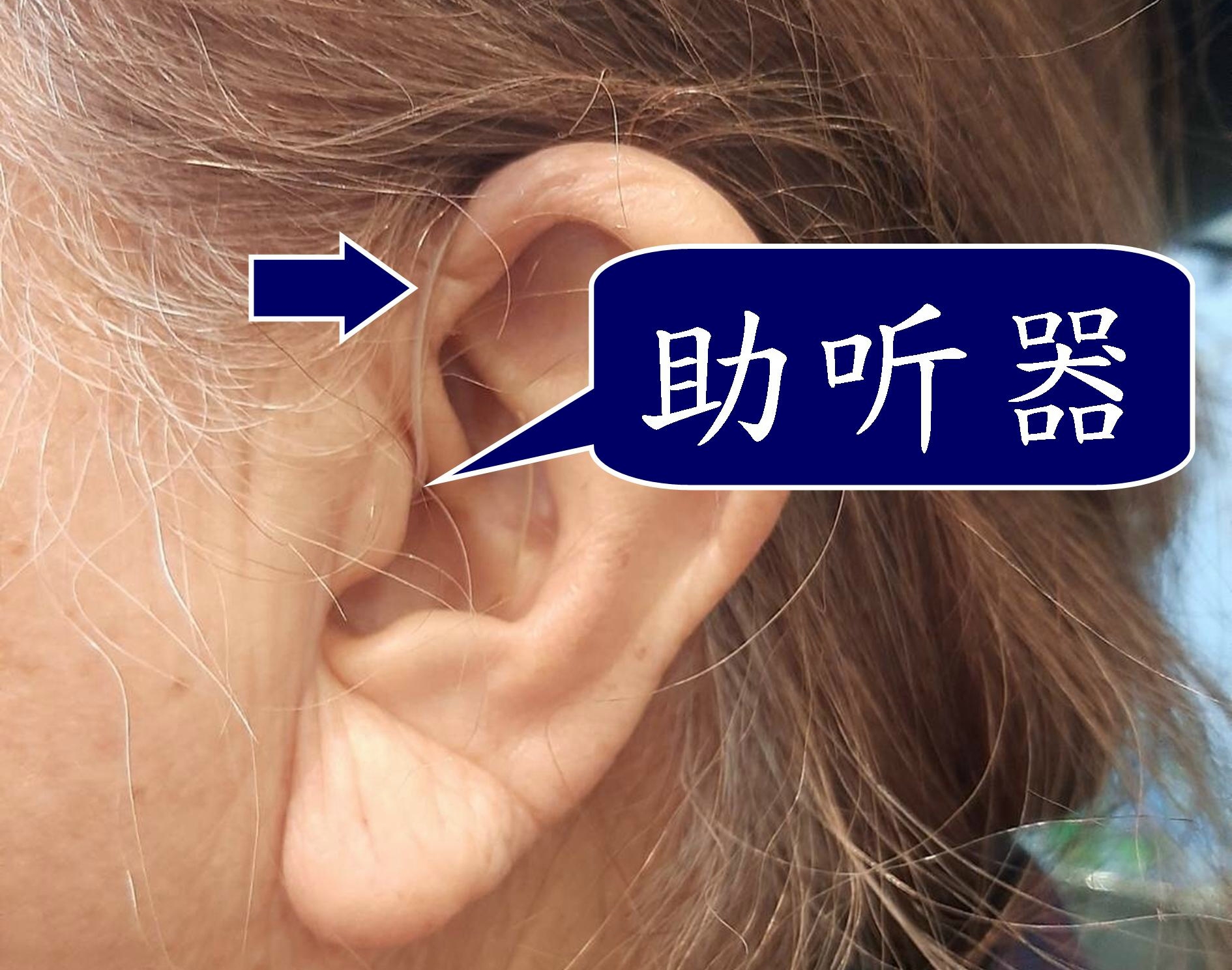 音樂耳症候群 圖三(大陸).jpg