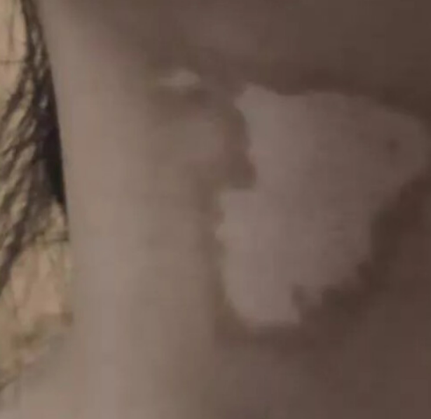 希格玛SQLED308白癜风光疗仪科普：患上了白癜风我们应该怎么治疗？