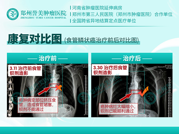 陕西食管癌 李志强.jpg