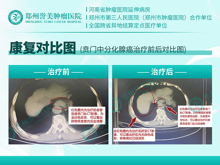 安徽贲门癌 刘其新.jpg